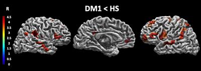 Abnormal Cortical Thickness Is Associated With Deficits in Social Cognition in Patients With Myotonic Dystrophy Type 1